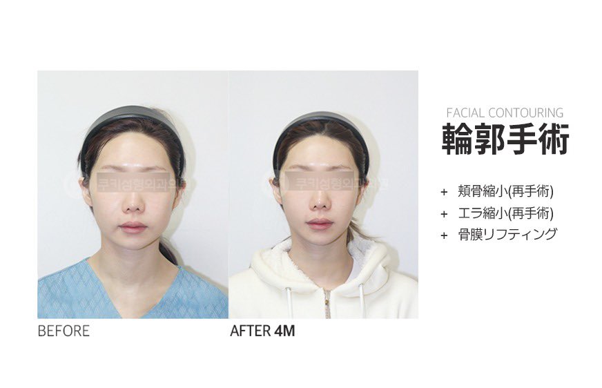 輪郭手術って、たるみが心配で悩む人も多そうだけど、「骨膜リフト」っていうのもあるんだね👀

顔って骨だけじゃないから、周りの組織まで一緒に考えてくれるっていうのが👍

症例見ると確かにスッキリしてるし、
分かりやすくて興味ある🤔
======
クッキー美容外科：@cookipskorea
#PR
====== https://t.co/SubOUrCuMl