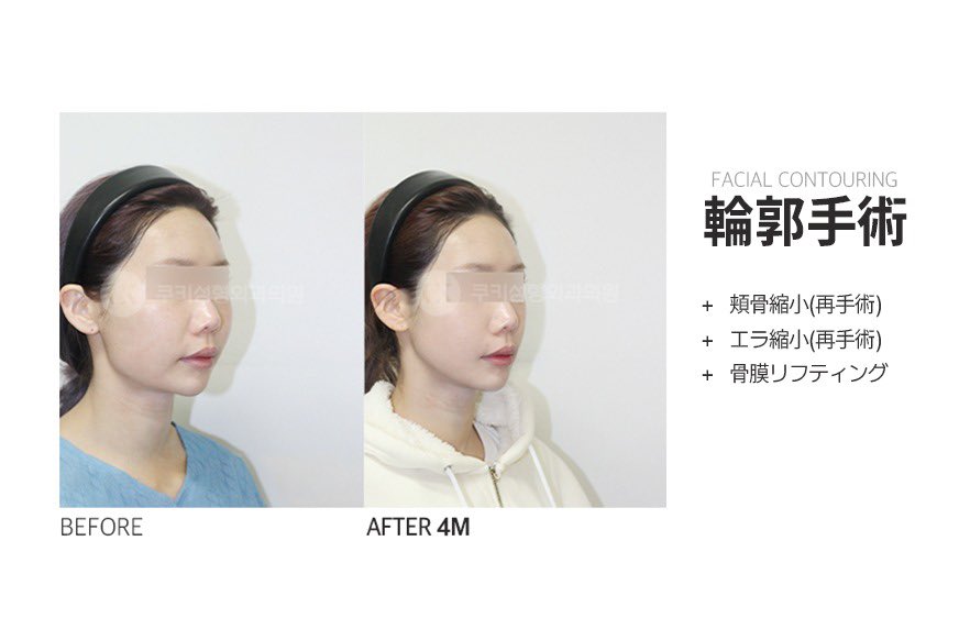 輪郭手術って、たるみが心配で悩む人も多そうだけど、「骨膜リフト」っていうのもあるんだね👀

顔って骨だけじゃないから、周りの組織まで一緒に考えてくれるっていうのが👍

症例見ると確かにスッキリしてるし、
分かりやすくて興味ある🤔
======
クッキー美容外科：@cookipskorea
#PR
====== https://t.co/SubOUrCuMl
