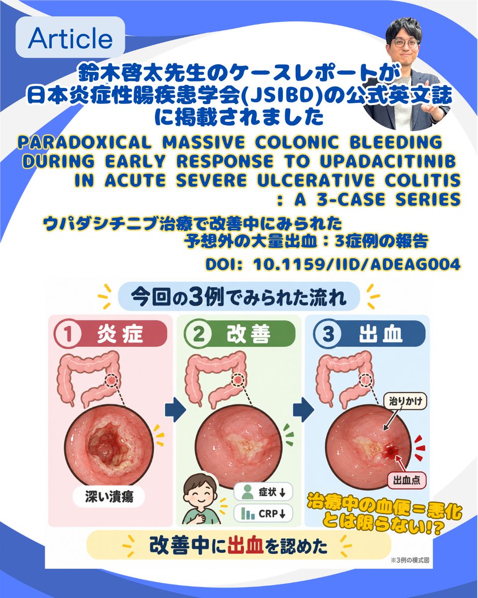 IBD59604947's tweet photo. 📢鈴木啓太先生のケースレポートが日本炎症性腸疾患学会の公式英文誌「Inflammatory Intestinal Diseases」に掲載されました。こんな偶然が3回も続く？とカンファレンスがザワついた症例シリーズです。ぜひご覧ください😄
#炎症性腸疾患先進治療センター #IBD #潰瘍性大腸炎 #casereport #IID #JSIBD https://t.co/A4uMxNolNG