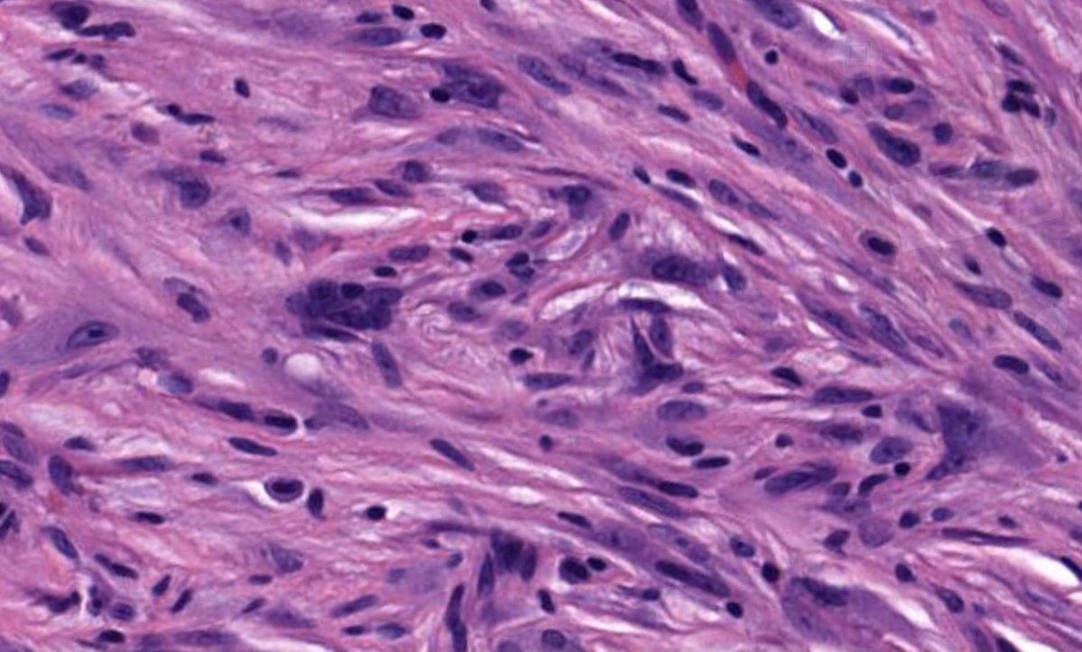 JMGardnerMD's tweet photo. 30 yo woman with back nodule. Clinical dx: “cyst”. (Hint: it’s NOT a cyst!) 
Answer ✅ https://t.co/4slCWFDaVE  
WSI digital slide https://t.co/rJikz7TLqw. 
#pathology #pathologists #pathTwitter #dermpath #dermatology #dermatologia #dermtwitter #bstpath https://t.co/OvxXWad6iM