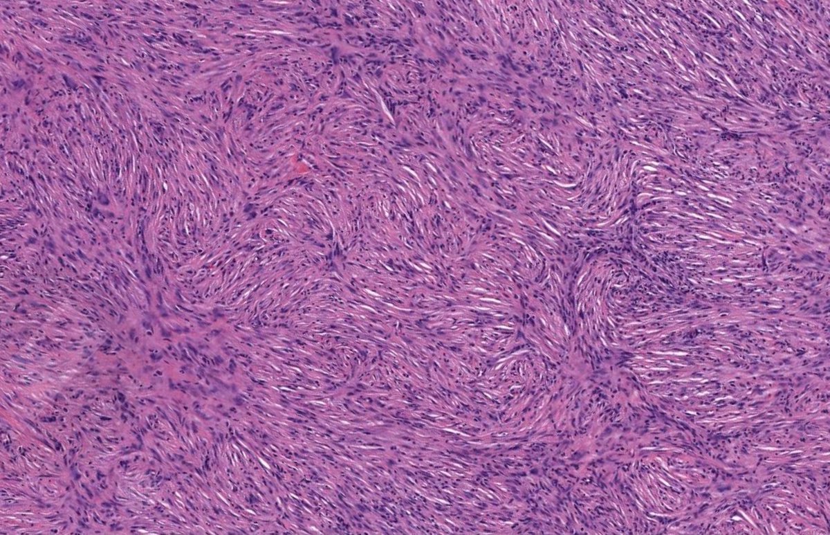 JMGardnerMD's tweet photo. 30 yo woman with back nodule. Clinical dx: “cyst”. (Hint: it’s NOT a cyst!) 
Answer ✅ https://t.co/4slCWFDaVE  
WSI digital slide https://t.co/rJikz7TLqw. 
#pathology #pathologists #pathTwitter #dermpath #dermatology #dermatologia #dermtwitter #bstpath https://t.co/OvxXWad6iM