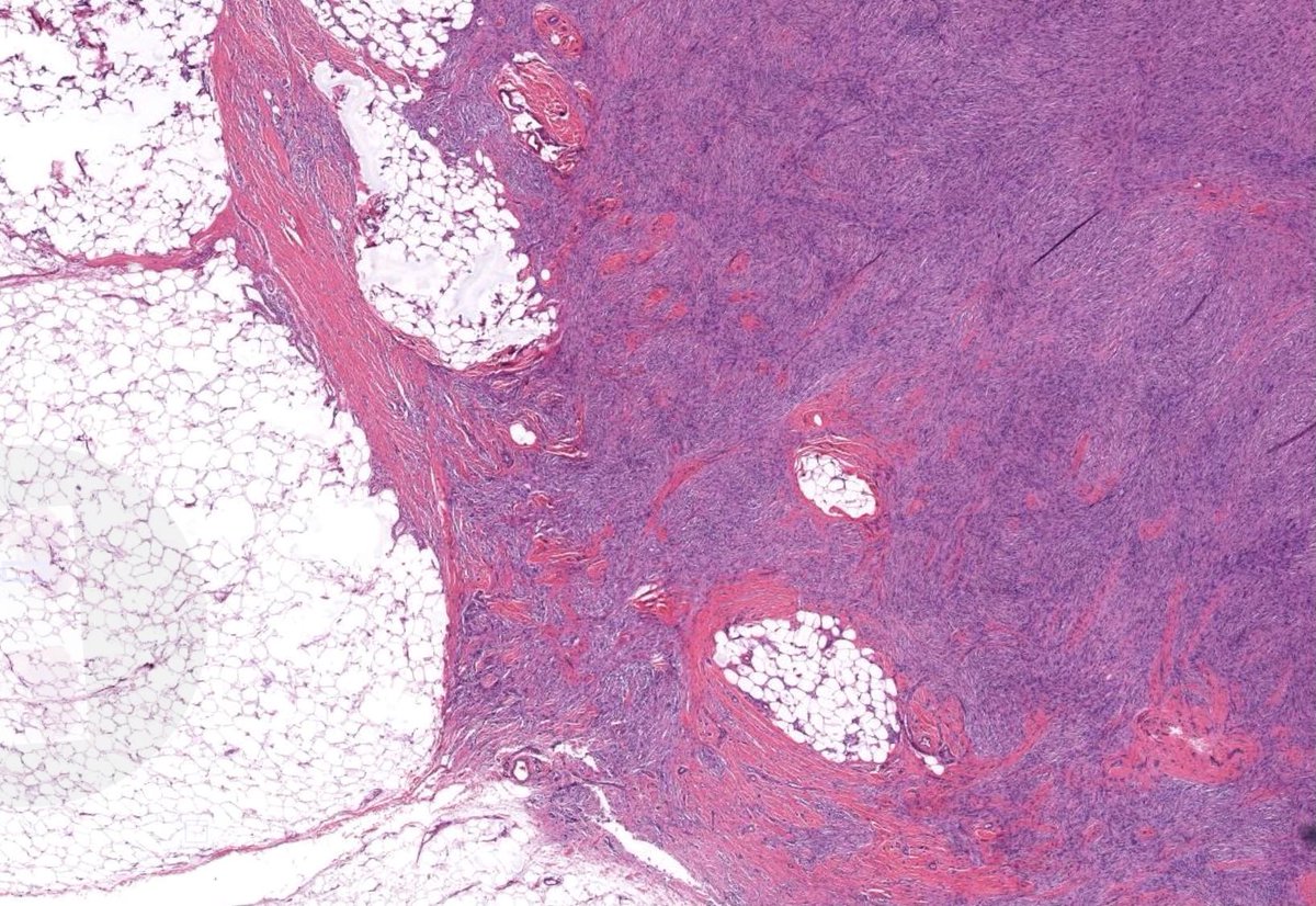 JMGardnerMD's tweet photo. 30 yo woman with back nodule. Clinical dx: “cyst”. (Hint: it’s NOT a cyst!) 
Answer ✅ https://t.co/4slCWFDaVE  
WSI digital slide https://t.co/rJikz7TLqw. 
#pathology #pathologists #pathTwitter #dermpath #dermatology #dermatologia #dermtwitter #bstpath https://t.co/OvxXWad6iM