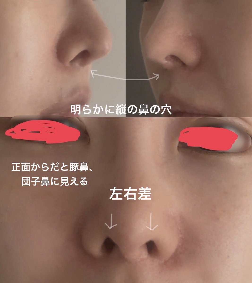 拡散希望

鼻整形失敗かも。執刀医「これ以上ご希望に沿った結果を責任持ってお約束することが難しい」「理想のデザインに近づけるなら軟骨取って建て直ししかない（自費）」←それなら初めからそう言って欲しい。
大金払ってこの仕上がりといわれたらこの執刀医に任せたいと思いますか？

#鼻整形 https://t.co/NCzq1Lx5pA
