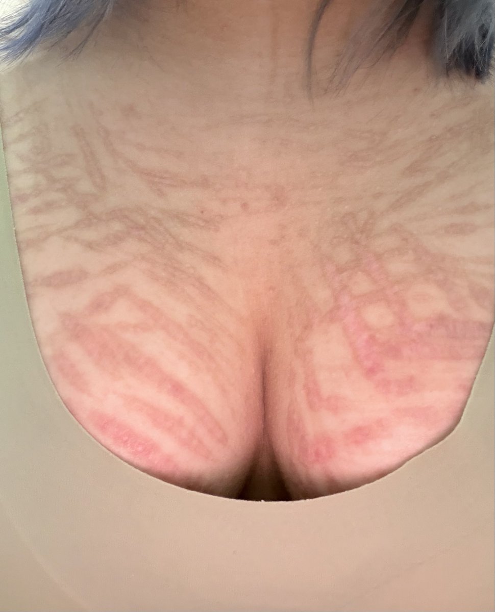 Jiqb0v's tweet photo. 我的疤。看起來很惡心哦 https://t.co/laqxS0bVQQ