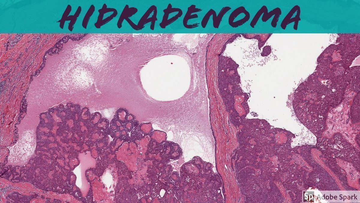JMGardnerMD's tweet photo. Nodular &amp; Cystic Hidradenoma (aka Acrospiroma). 2 Minute Video: https://t.co/HCAdASUYDT.  WSI digital slide via @pathpresenter: https://t.co/YXFbbldtsl. @mydermpath #pathology #pathologists #pathTwitter #dermpath #dermatology #dermatologia #dermtwitter https://t.co/e7XkHQgklm