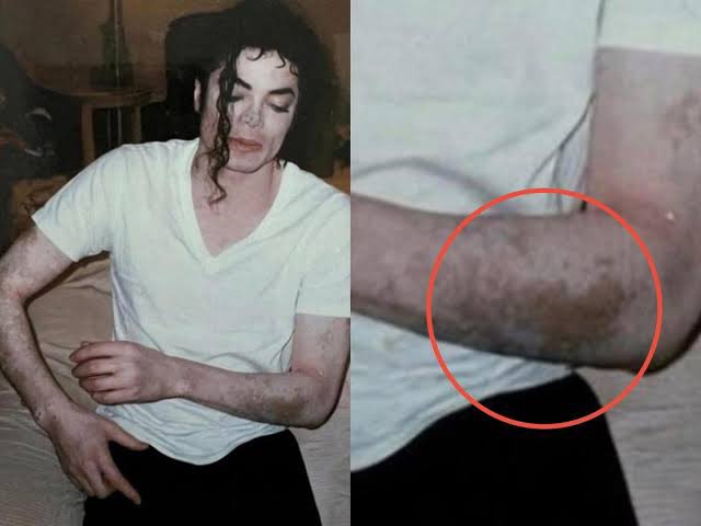historyrock_'s tweet photo. In the mid-1980s, Michael Jackson began to develop vitiligo, a condition that causes the loss of melanin and the appearance of progressively lighter patches on the skin. 

Over time, the patches became more extensive and visible, while the press constantly speculated about the changes in his appearance. 

Jackson publicly explained his condition during his famous interview with Oprah Winfrey in 1993. To even out the tone of the affected areas, he used makeup, and when the depigmentation became extensive, he turned to medical treatments designed to even out his skin tone. Complete depigmentation can be used in cases of very widespread vitiligo, although it is a permanent process. 

For years, vitiligo was one of the most misunderstood aspects of his physical transformation. Paradoxically, his case ended up becoming one of the best-known stories associated with this condition.