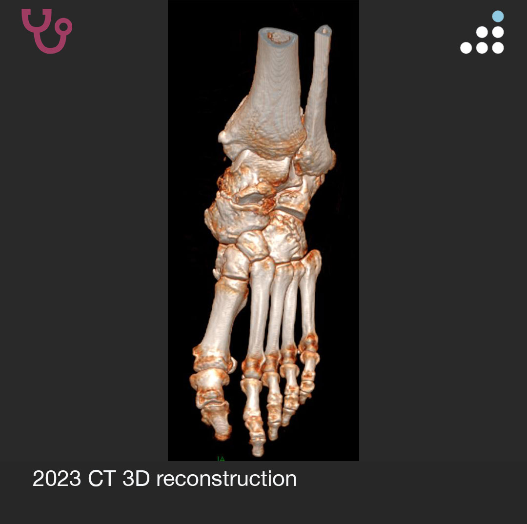 orthobullets's tweet photo. Here are the 2023 CT 3D reconstruction images. https://t.co/Y02xKT6Czs