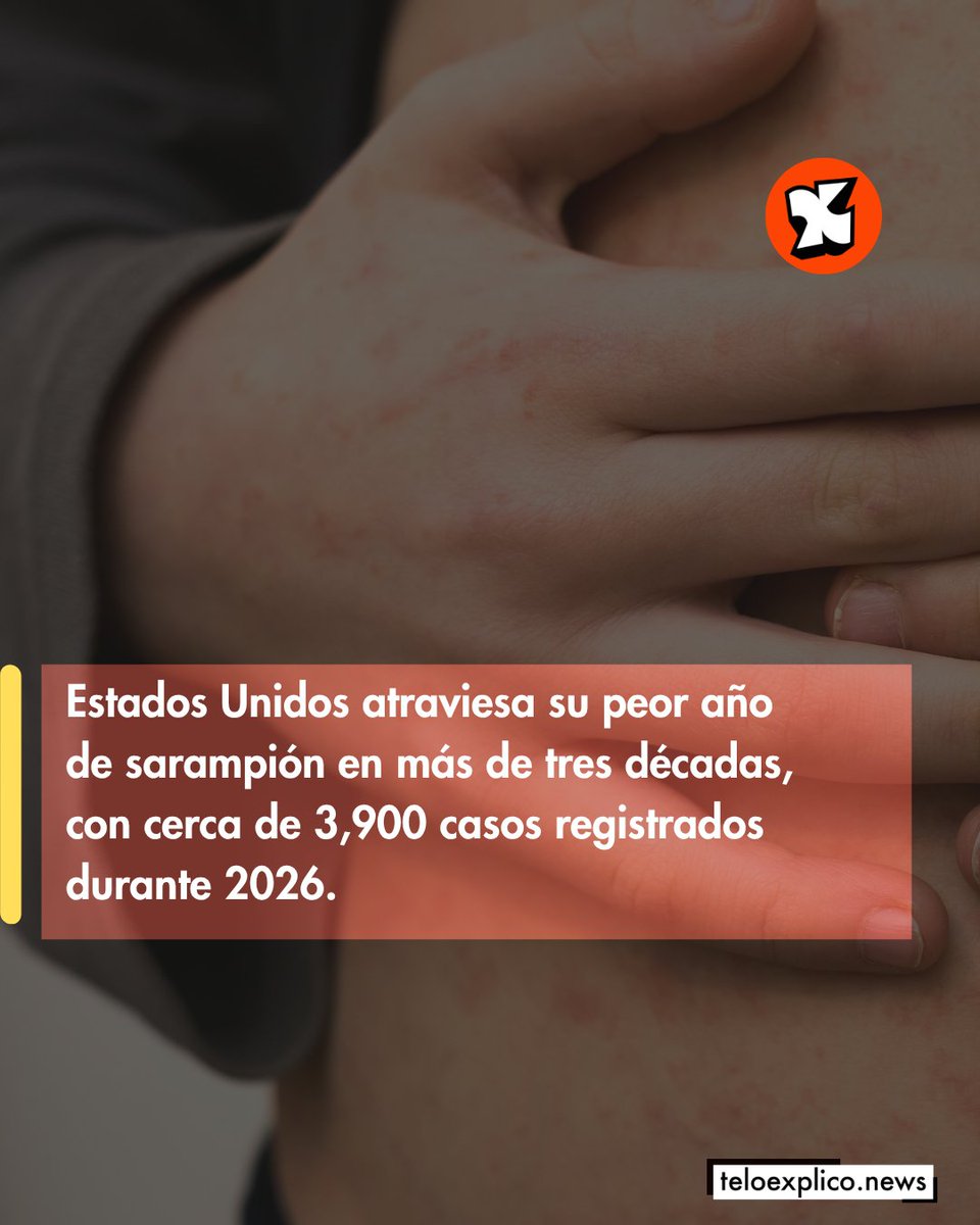 Teloexpliconews's tweet photo. Estados Unidos atraviesa una situaciรณn que ha llamado la atenciรณn porque se trata de una enfermedad cuya transmisiรณn endรฉmica habรญa sido declarada eliminada en el paรญs en el aรฑo 2000.
#TeLoExplico #TeLoExplicoNoticias #TeloExplicoNews https://t.co/G63GSWDuXv