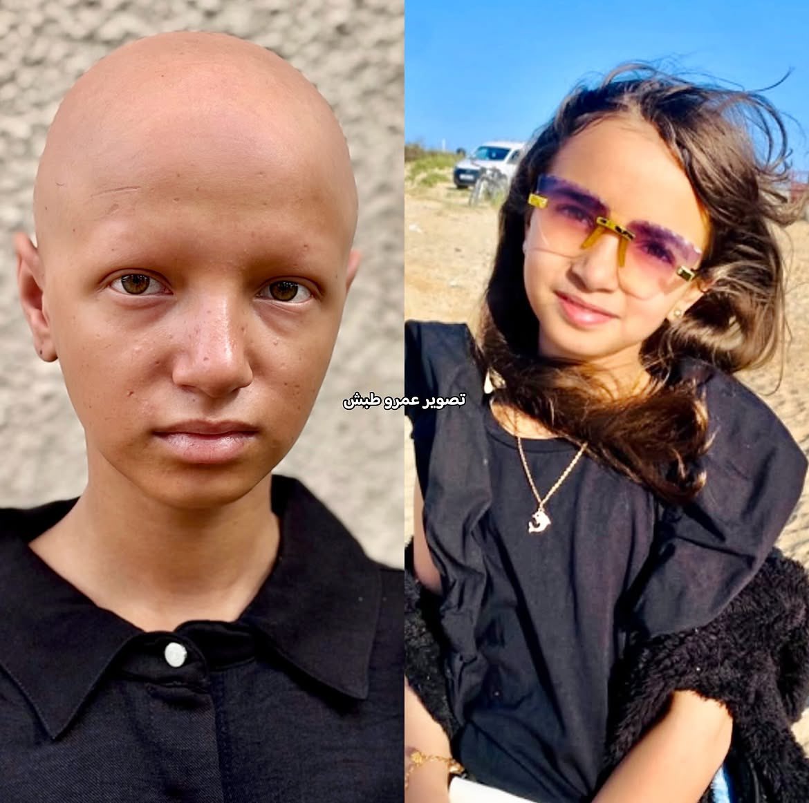 Tamer_Alnoaizy's tweet photo. Sana is only 12 years old. She lost her hair from the extreme fear she experienced in Gaza.

Can you imagine what this child saw, and how much fear and pain she endured for her body to lose its hair? https://t.co/AyGddy9uWu