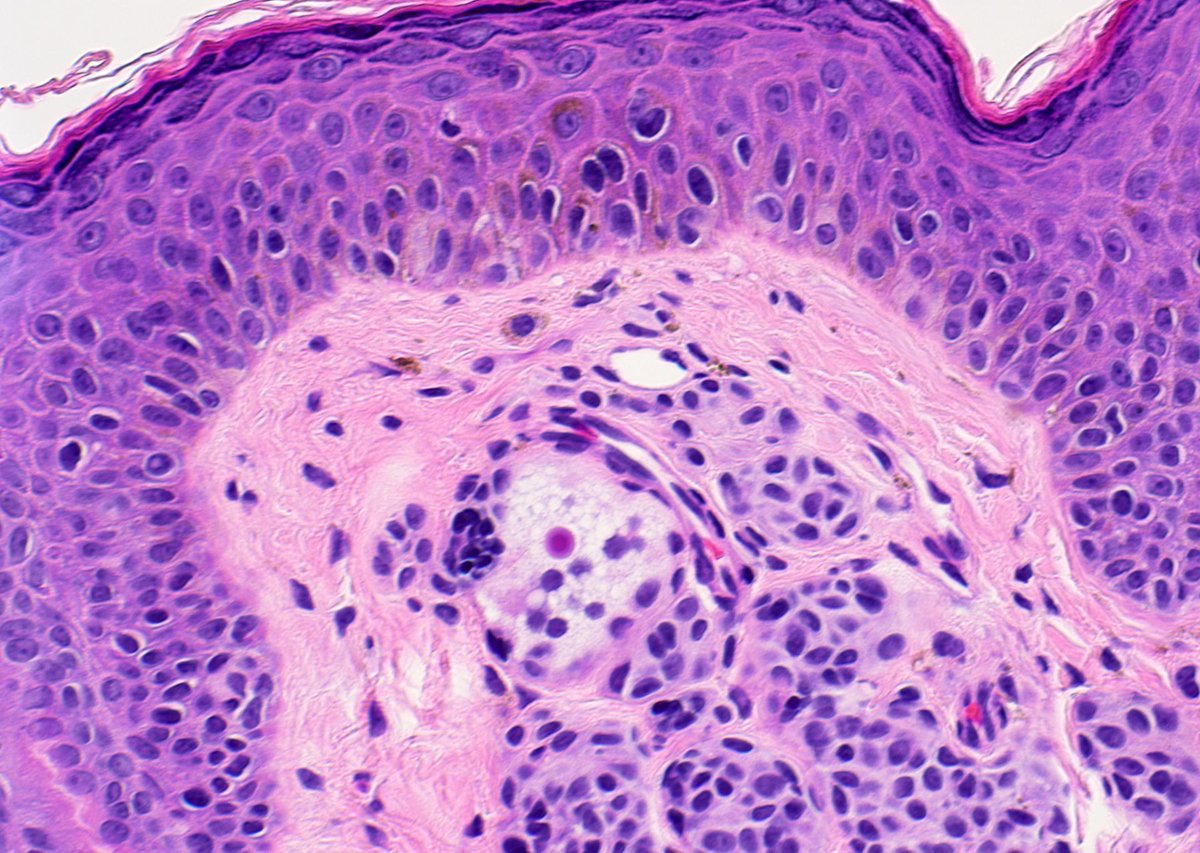 JMGardnerMD's tweet photo. What is this cell? What is the pink dot in its cytoplasm? What is the diagnosis?
Answers ✅ https://t.co/37z9tiICoE 
#pathology #pathologists #pathTwitter #dermpath #dermatology #dermatologia #dermtwitter https://t.co/R37DoEfDFm