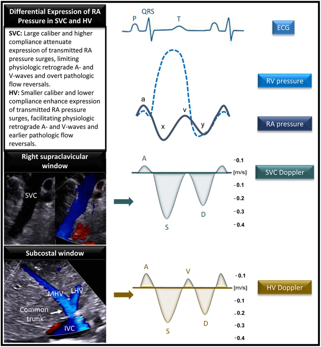 ASE360's tweet photo. We've released a #new State-of-the-Art Review, "Discordant Superior Vena Cava and Hepatic Vein Doppler: A Physiologic and Imaging Framework!"

Read our @JournalASEcho article: https://t.co/C4v97iq3oE https://t.co/DfAr3ePiwl