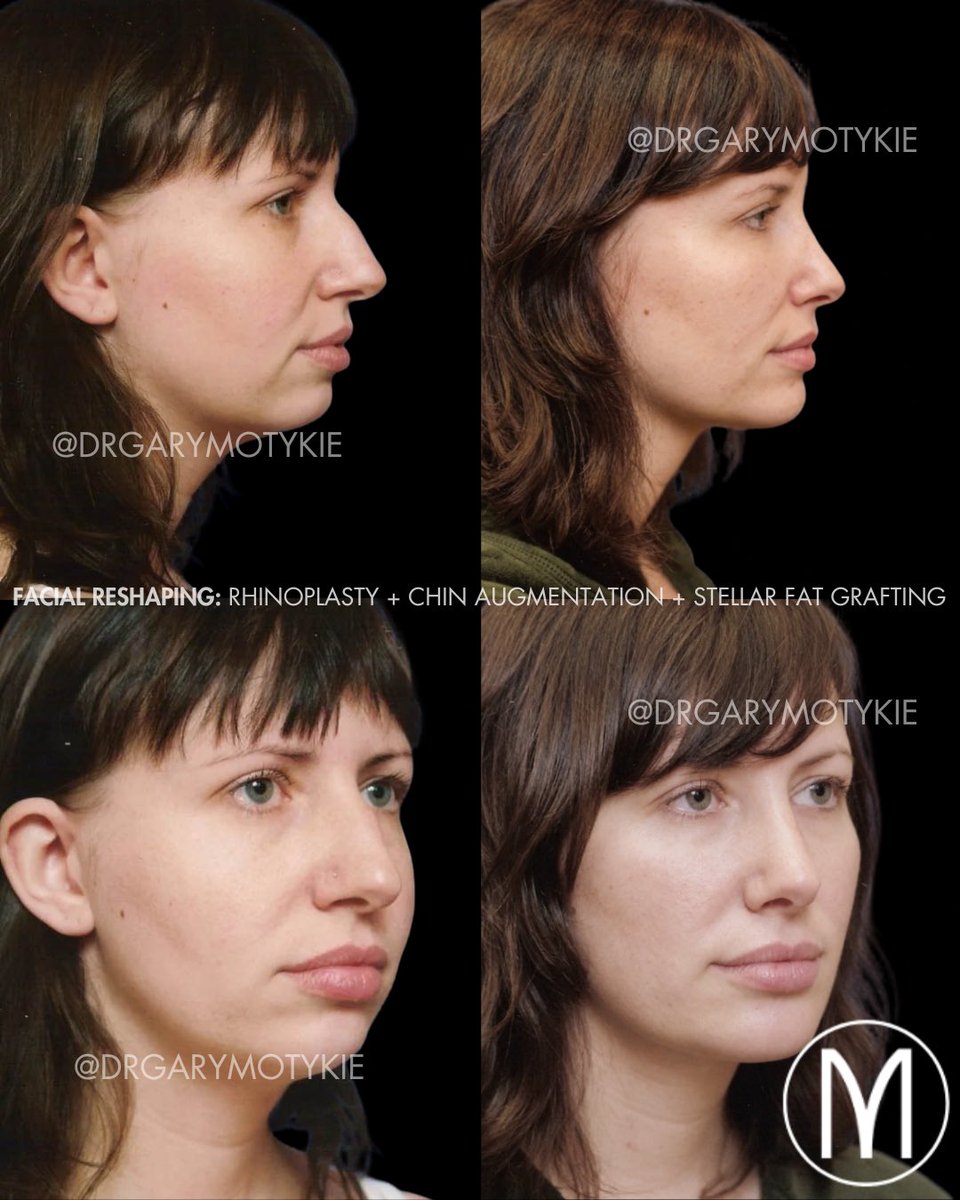 DrGaryMotykie's tweet photo. This 30-year-old patient underwent rhinoplasty, chin augmentation, and facial fat grafting. By addressing the nose, chin, and facial volume together, my goal was to create greater balance while preserving her individual character.
#PlasticSurgery #NoseJob https://t.co/CPtWl8keMP