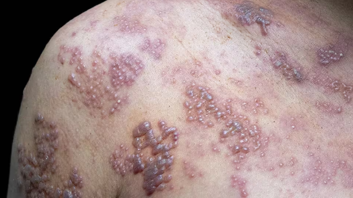 JeffCassman's tweet photo. Virologists, immunologists and know-it-alls:  My MD *strongly* encourages me to get the shingles vaccine.  He doesn't care about the Wuhan or Flu vaccine.  I have a friend who suffered terribly from shingles.  Yes, I had the Pox as a kid.  Suggestions?  Picture is just to get your attention.
