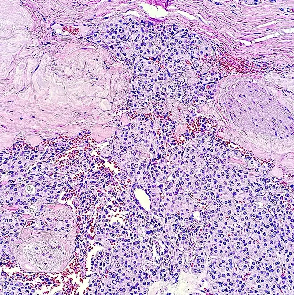 Gloria_SuraMD's tweet photo. Thyroidectomy revealing a follicular lesion with capsular invasion but without papillary nuclear features. What is the diagnosis? Answer: https://t.co/pI1AS4kYAz #PathArt #PathTwitter #MedTwitter https://t.co/DIhp9bDRUz