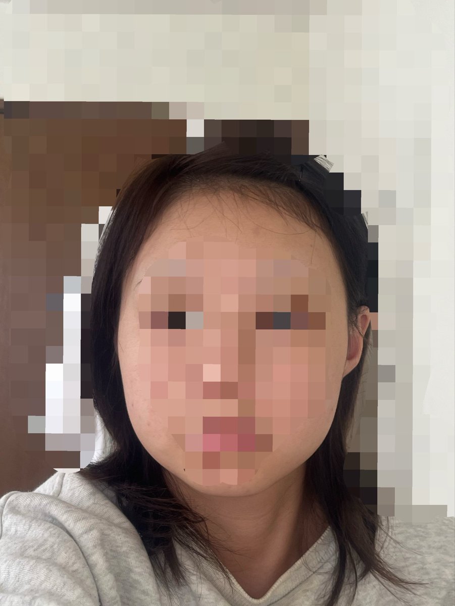 ur7cpn's tweet photo. 頬顎下ジョール脂肪吸引
術前・術後1日目です
わかりずらいですがかなりシュッといていて涙出ます😭 https://t.co/h04BRYgpjh