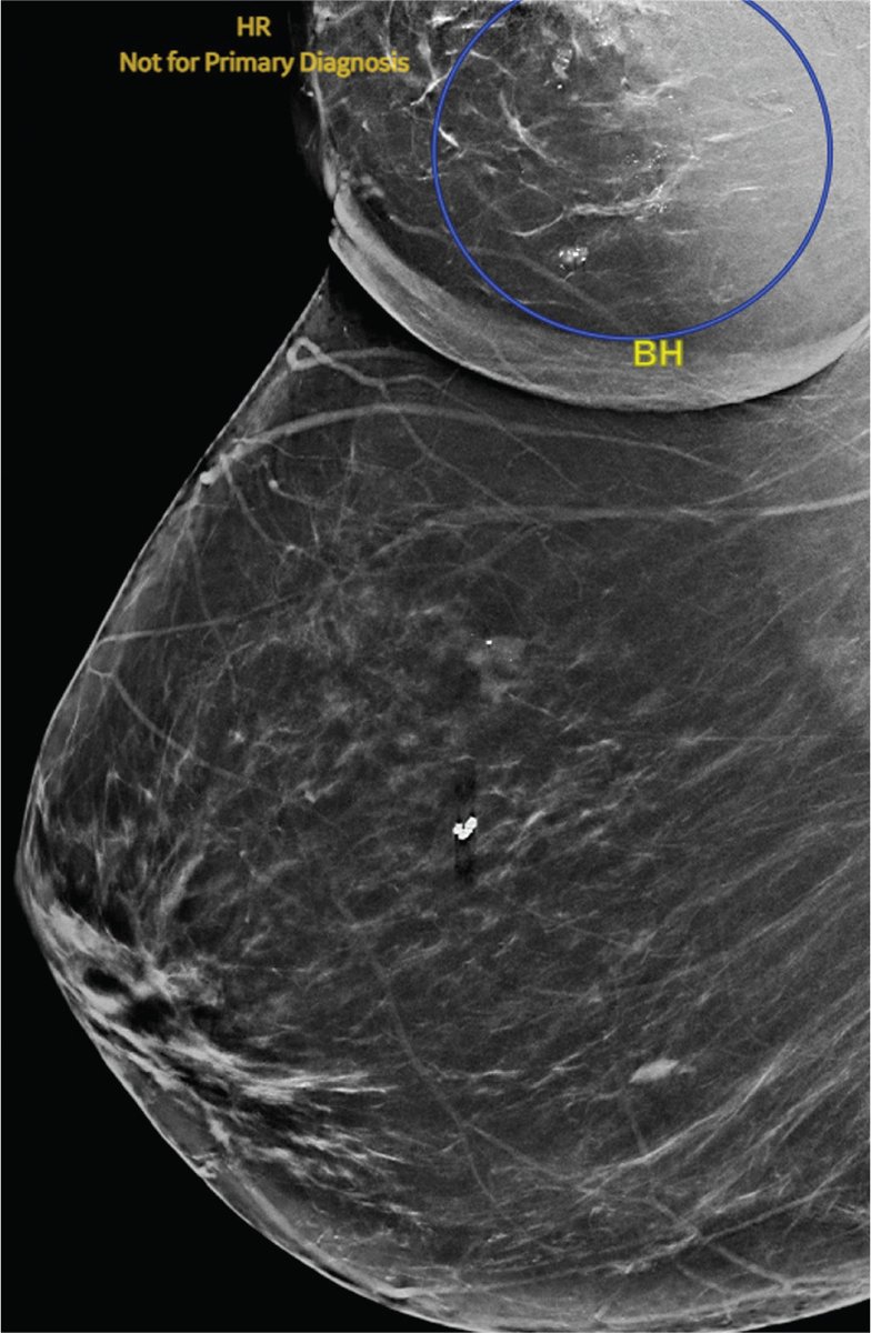 Applied_RadOnc's tweet photo. Radiation Therapy in Cancer of Accessory Breast Tissue: Questions for Treatment Guidelines, Case Series, and Literature Review
 
🔗 Full article here: https://t.co/Mr9gehFpYO 

#BreastCancerAwarenessMonth #BreastCancerAwareness #BreastCancer #RadOnc #RadOncEd https://t.co/rFsbISNLHA