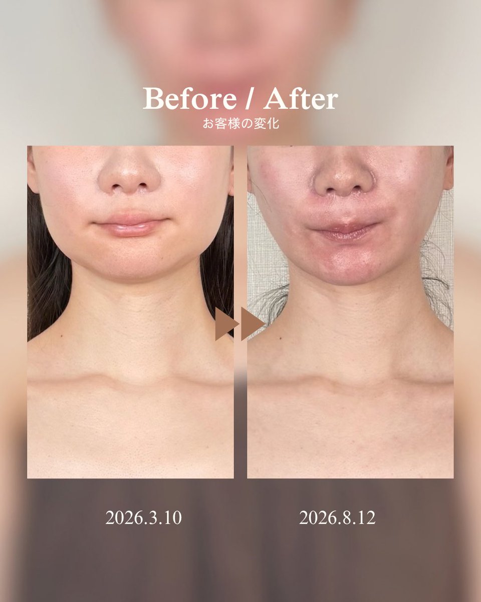 INDIBA_OnpaLabo's tweet photo. 小顔になりたいなら、やっぱり輪郭3点？👀

今回のBefore / After、正面だけじゃなく横顔まで見てほしい。

クリニック：Girin美容外科様
手術部位：輪郭3点

特にフェイスライン〜顎先の変化に注目。 https://t.co/bb7skZmz6G