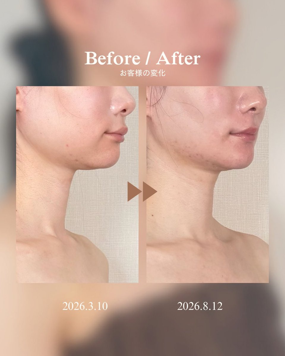 INDIBA_OnpaLabo's tweet photo. 小顔になりたいなら、やっぱり輪郭3点？👀

今回のBefore / After、正面だけじゃなく横顔まで見てほしい。

クリニック：Girin美容外科様
手術部位：輪郭3点

特にフェイスライン〜顎先の変化に注目。 https://t.co/bb7skZmz6G