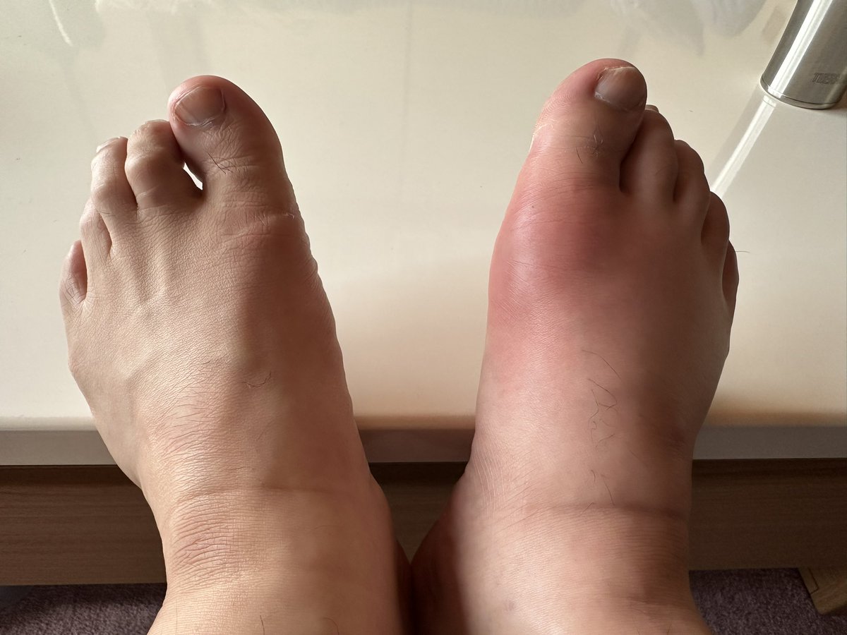 negio_jr's tweet photo. 右足がこんなになっちゃった😭
痛いよー😣
#痛風 https://t.co/d1tsbWRgx1