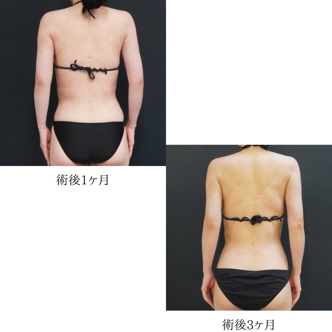 MatayoshiHideki's tweet photo. 個人差はありますが、内出血は1ヶ月程度で落ち着きます。

1週間くらいまではボレロの着脱や着替えがしづらいことがありますが、徐々に回復していきますのでご安心ください。

二の腕の張り出しが気になる方はぜひご相談ください。 https://t.co/9hi0iQGFy0