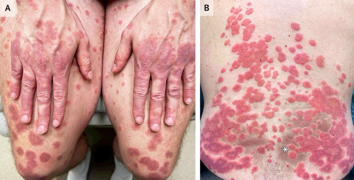 Aller_MD's tweet photo. Images in Clinical Medicine: #Urticarial #Vasculitis | #NEJM https://t.co/WapbYnbCTR https://t.co/VdavRcBOTY