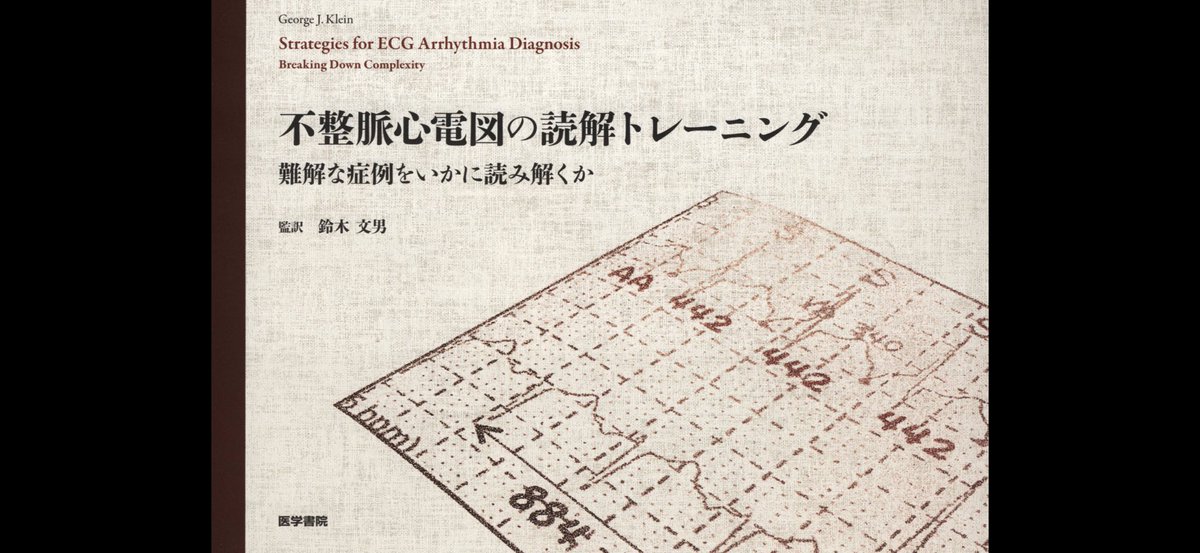 ECGEPSCADEVICE's tweet photo. 「問題7-4」のlong RP頻拍はヒス不応期PVCでP波を「advance」して頻拍が停止しているので伝導速度が遅い副伝導路(減衰伝導特性は無い🌟)を介するORTであることが分かります🙇‍♂️🔥🔥🔥🔥🔥 https://t.co/mkyaaWeNhe