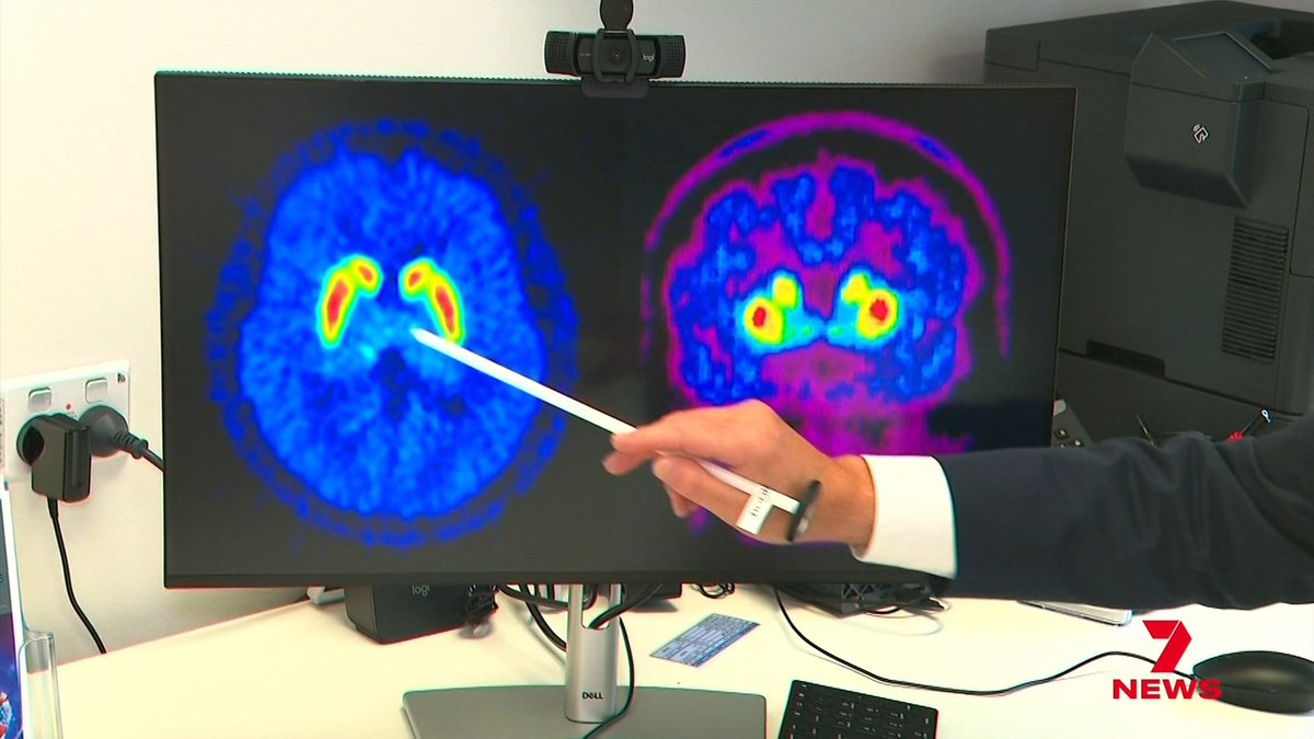 A person points a pen at a computer monitor displaying two colorful brain scans, highlighting areas of brain inflammation that a new pill has shown promise in reducing. The "7 NEWS" logo is visible in the bottom right corner, indicating the image accompanies a news report about Australian researchers' progress toward treating Parkinson's disease before symptoms appear.