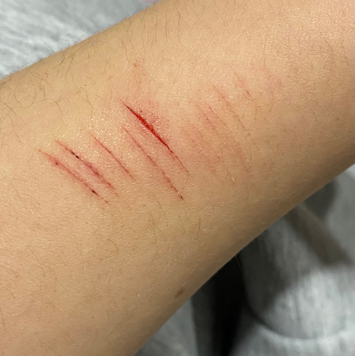 sophiaham84's tweet photo. TW! Halloween sfx cut makeup done by my friend. All fake! Fake cuts! 

Can anyone tell me if this is a baby styro or cat scratch? https://t.co/6n3uIGGDik