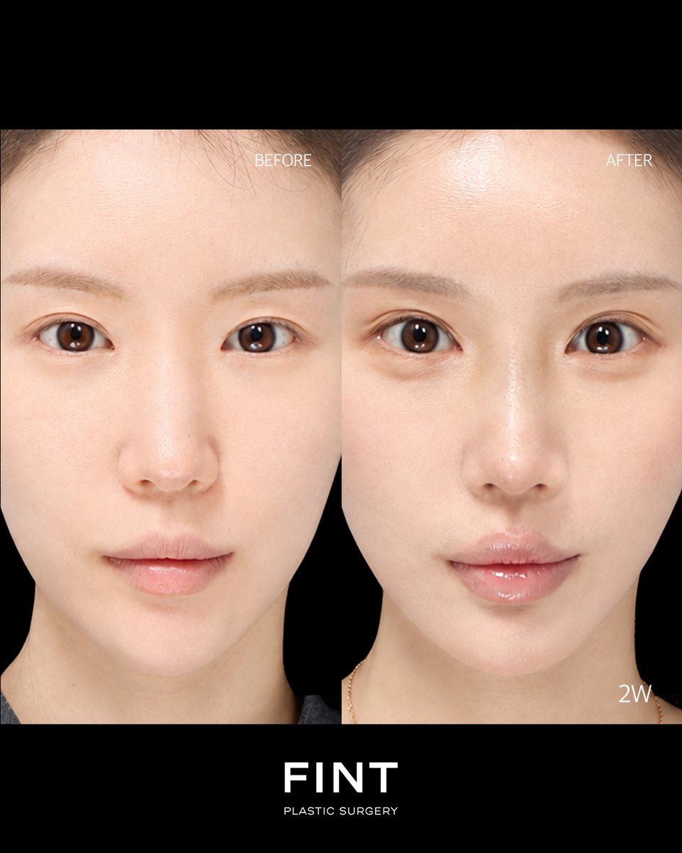 FINT_jp's tweet photo. 【FINT美容外科　鼻２回目再整形】

希望：
・自然と華やかの中間
・全体的に鼻を高くしたい
・以前の手術で変化なかったため変化を出したい
・中間面を短く改善希望

手術２週間目症例

 【手術内容】
鼻２回目再手術
鼻筋：プロテーゼ
鼻先：鼻中隔延長(自家肋軟骨)/鼻尖形成(耳介軟骨)/鼻唇角矯正(猫手術)/鼻柱下降/ピーチノーズ矯正（自家肋軟骨骨膜）

📩ご予約・ご相談はLINEまで
LINE：https://t.co/5nW4AwnbM7

#FINT美容外科　#ピント  #鼻整形
#鼻手術　#韓国美容