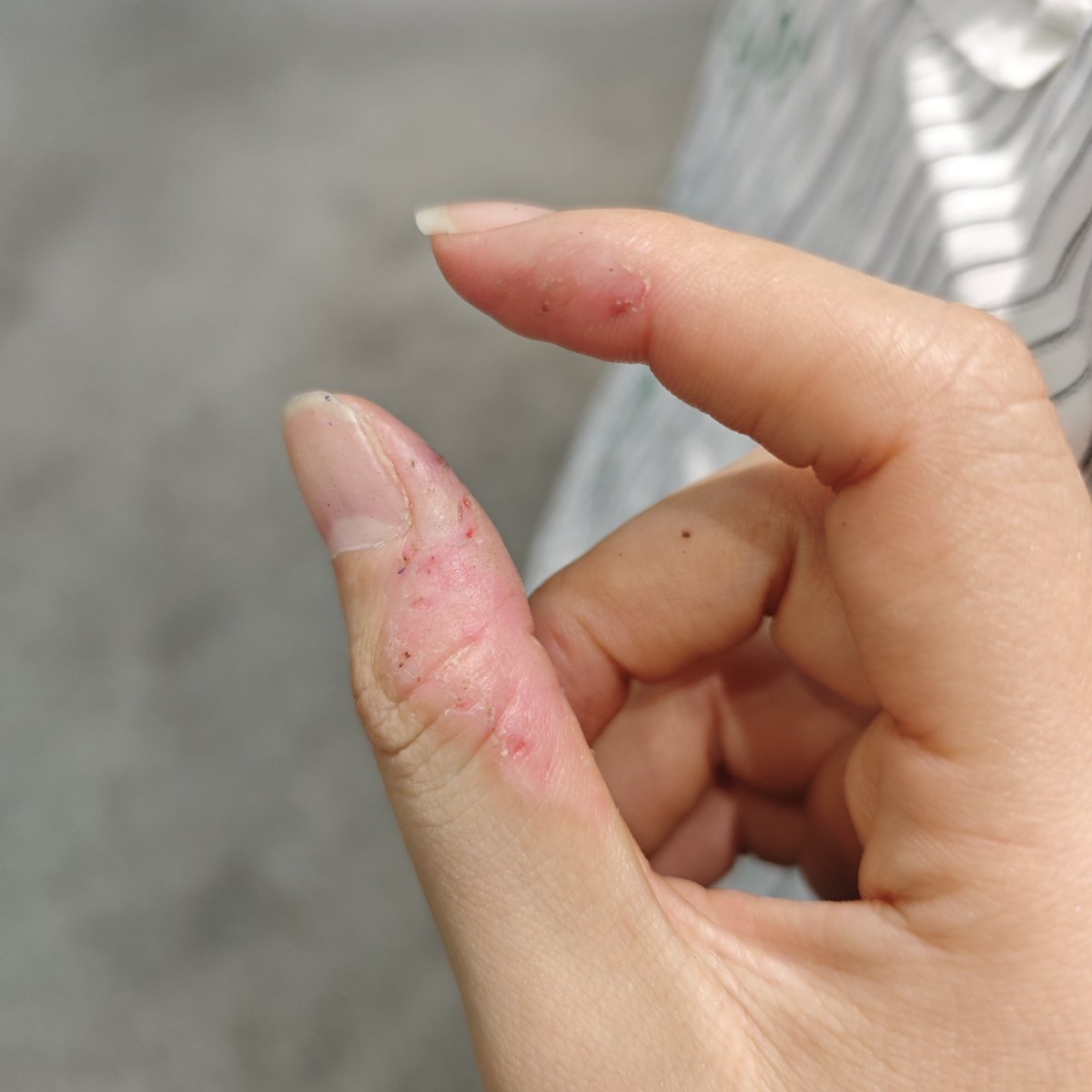 LanQing0328's tweet photo. *烦...
各种事都在焦虑。
感觉真得���人管我。
不然我将一直抠这个手... https://t.co/7hl3rkTSB5