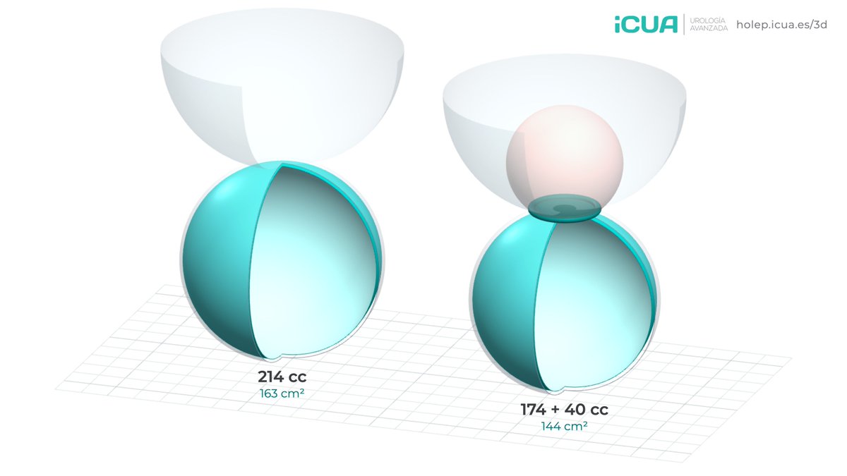 fgomsan's tweet photo. Why is HoLEP size-independent? Simple geometry.

From 30 to 500 cc we remove 48× more adenoma, but the enucleation plane grows only 13×. A median lobe adds only its base.

Interactive 3D model + free slides in 8 languages:
https://t.co/JBSZYYuVbo

#HoLEP #Urology
https://t.co/JBSZYYuVbo
#HoLEP #Urology
