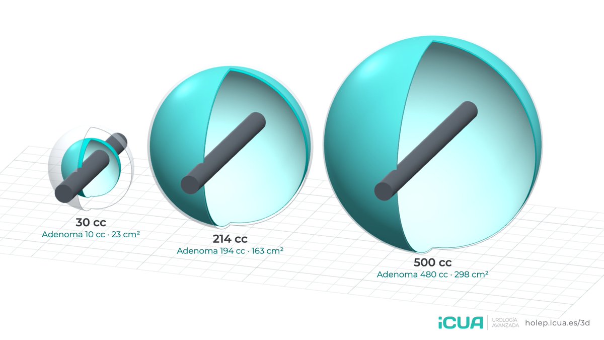 fgomsan's tweet photo. Why is HoLEP size-independent? Simple geometry.

From 30 to 500 cc we remove 48× more adenoma, but the enucleation plane grows only 13×. A median lobe adds only its base.

Interactive 3D model + free slides in 8 languages:
https://t.co/JBSZYYuVbo

#HoLEP #Urology
https://t.co/JBSZYYuVbo
#HoLEP #Urology