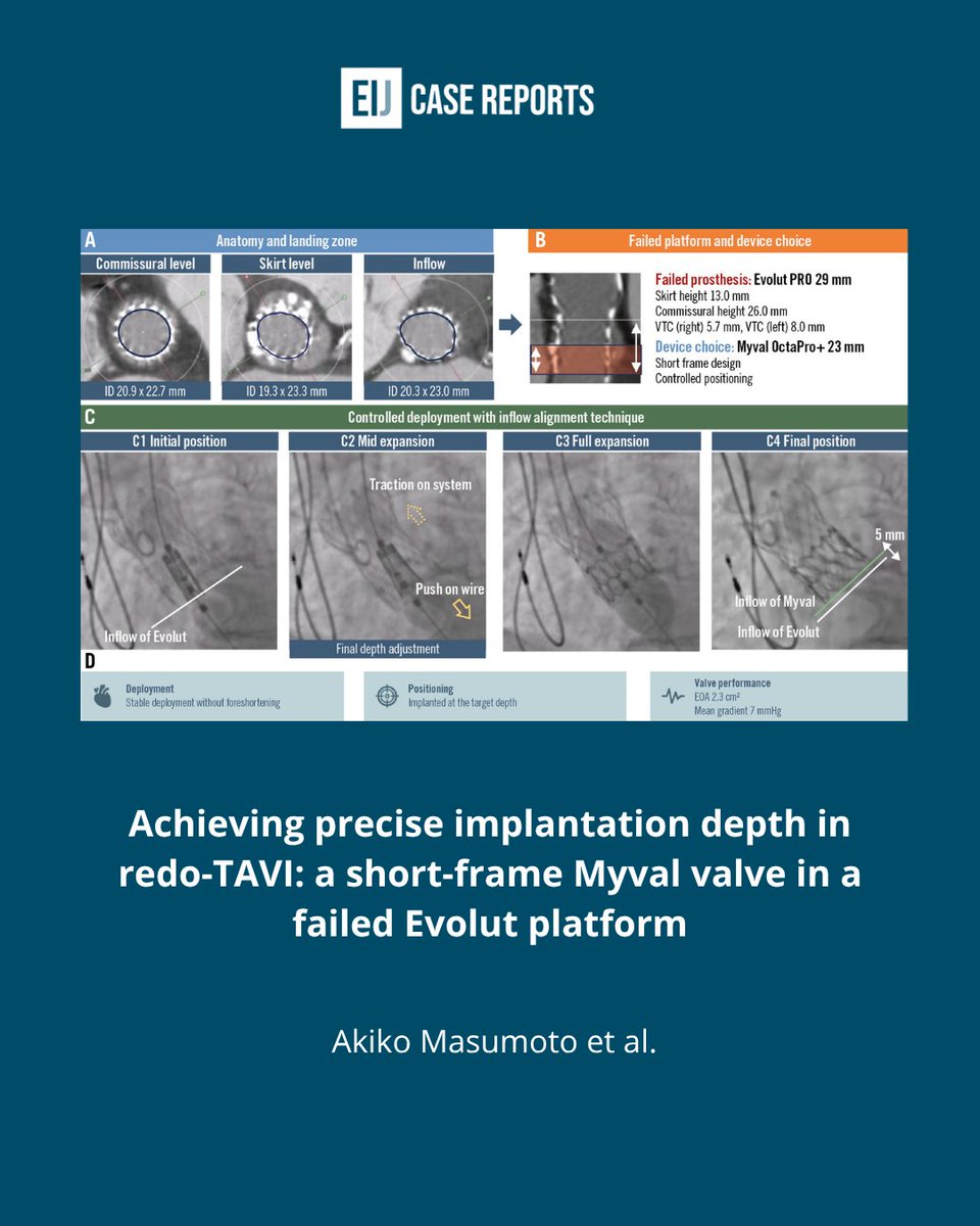 EIJCaseReports's tweet photo. 🔍 Can you avoid unpredictable valve foreshortening during redo-TAVI?
Facing a failed Evolut PRO, Akiko Masumoto et al. aimed for a precise 5 mm target depth. Discover the specific deployment technique 👇
https://t.co/oJwuIg4zwK
#RedoTAVI #TAVI #Cardiology https://t.co/EnsqCZ8K47