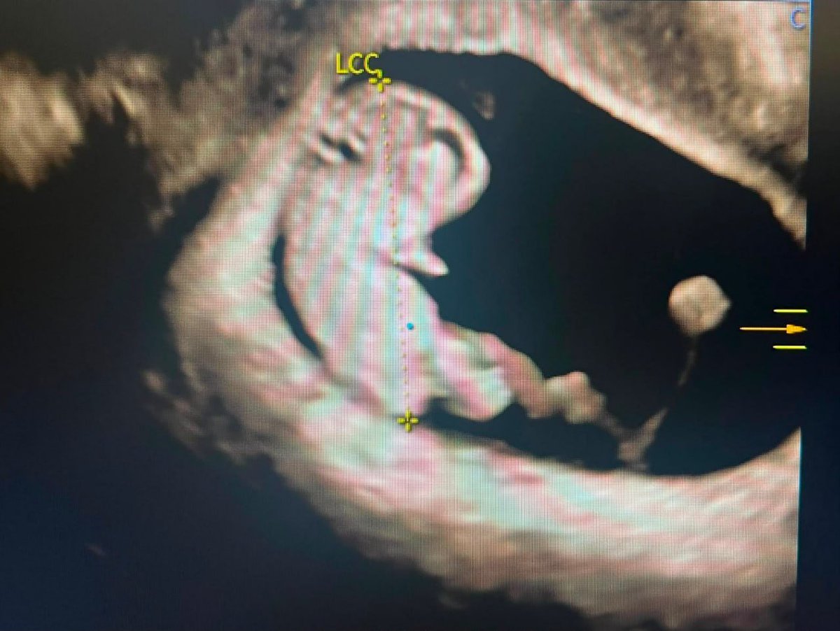NatuVitro's tweet photo. IVF with donor eggs can achieve success rates of 50% to 70% per embryo transfer, according to the article. Outcomes depend on donor age, sperm quality, uterine health and clinic expertise. Our team can support you.
https://t.co/7MohGcGK0U https://t.co/te93J5MBOS