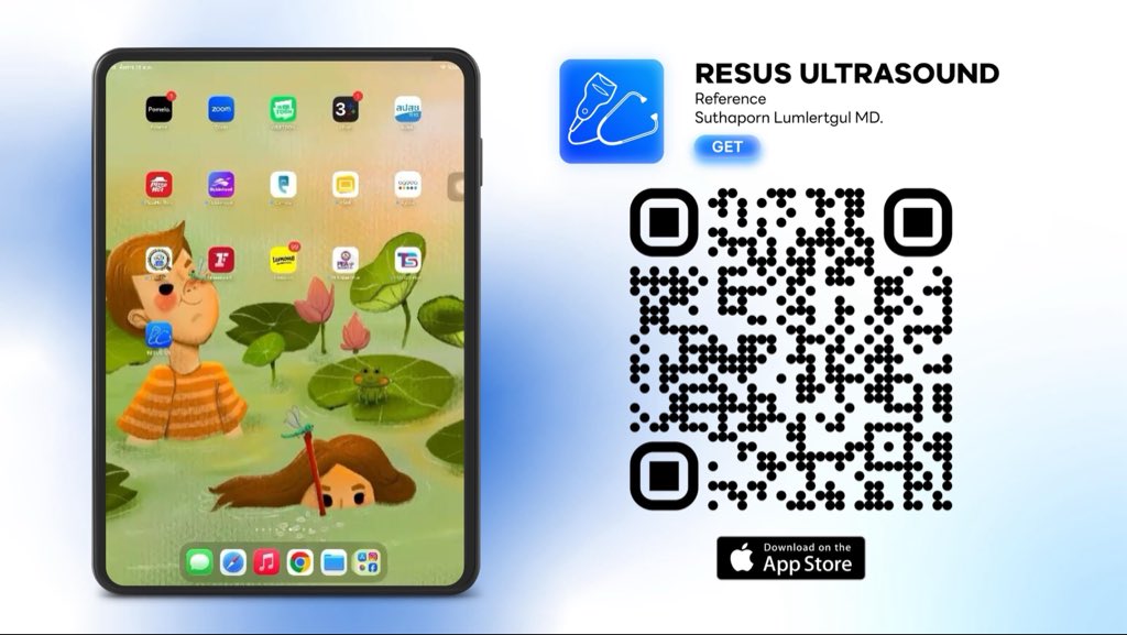 JollyERv2's tweet photo. #RCEPT26 ของฝากจากงานประชุมหมอฉุกเฉิน #แอปฟรีมีเกียรติ RESUS-US แอป reference สำหรับการทำ Point-of-Care-Ultrasound (POCUS) มีครบแทบทุก view และทุก parameter ที่ต้องใช้ใน ER 

ของดีและฟรีมีอยู่จริง ใช้มาตั้งแต่ Intern-Resident-Staff รวมเวลากว่า 10 ปี ใช้แล้ว ใช้อยู่ ใช้ต่อไป ใช้จนกว่าอาจารย์จะไม่ให้ใช้ 555 

Credit เพจ Resuscitation&Ultrasound 😁🙏🏻

Link: https://t.co/VV4ZSLRxPR