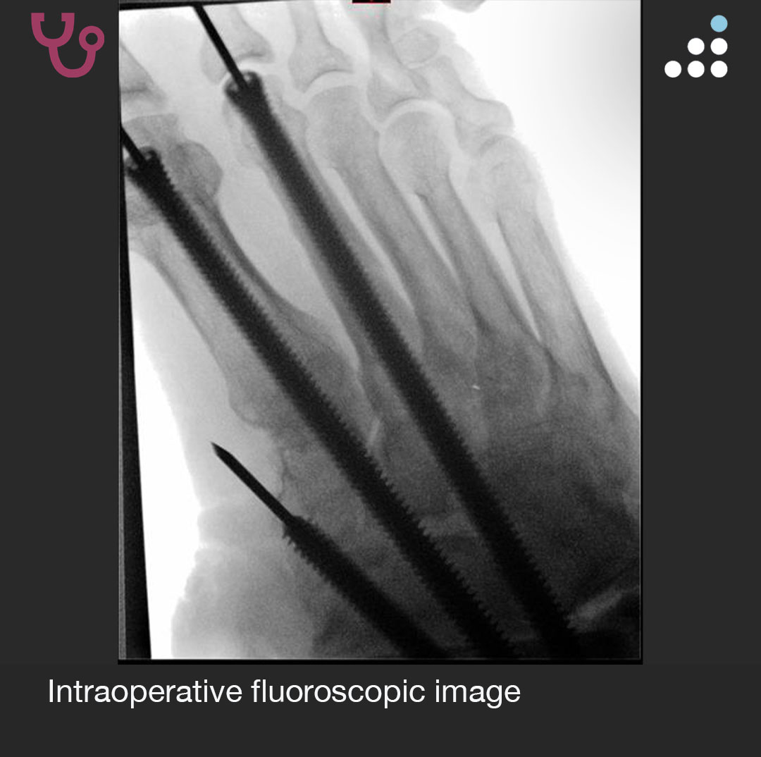 orthobullets's tweet photo. Here are the intraoperative fluoroscopic images. https://t.co/3PzlCsP6mh