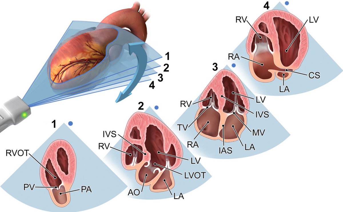 NephroP's tweet photo. Same window - different views.
#echofirst views obtained from the apical window by fanning the transducer.
Courtesy: ASE TTE guidelines 2019
4. Coronary sinus view
3. Apical 4-chamber
2. Apical 5-chamber (LV outflow)
1. RV outflow
#POCUS #FOAMed #Nephpearls https://t.co/W7j518CrN2