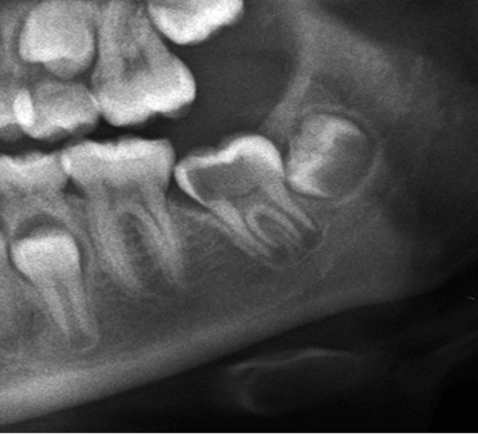 dentometric's tweet photo. Aparente lesión cariosa en un molar inferior no erupcionado

Enlace: https://t.co/ZqH9M8XS6M https://t.co/7veOpkNAbg