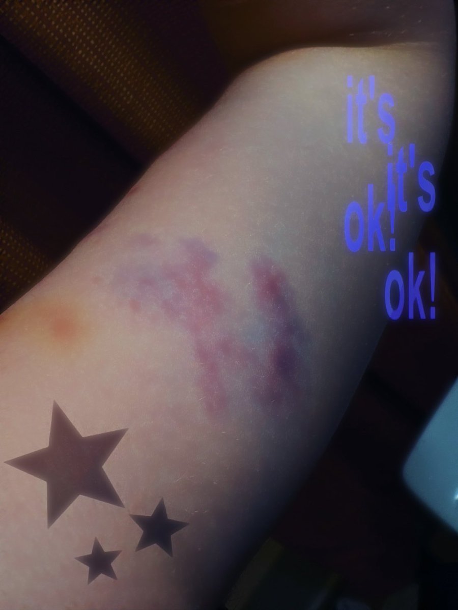 illusoryacc2's tweet photo. #bruises from da pit

                           i <3 them so bad    #shrtwt #shedrtwt https://t.co/4SwfK7Zlpa