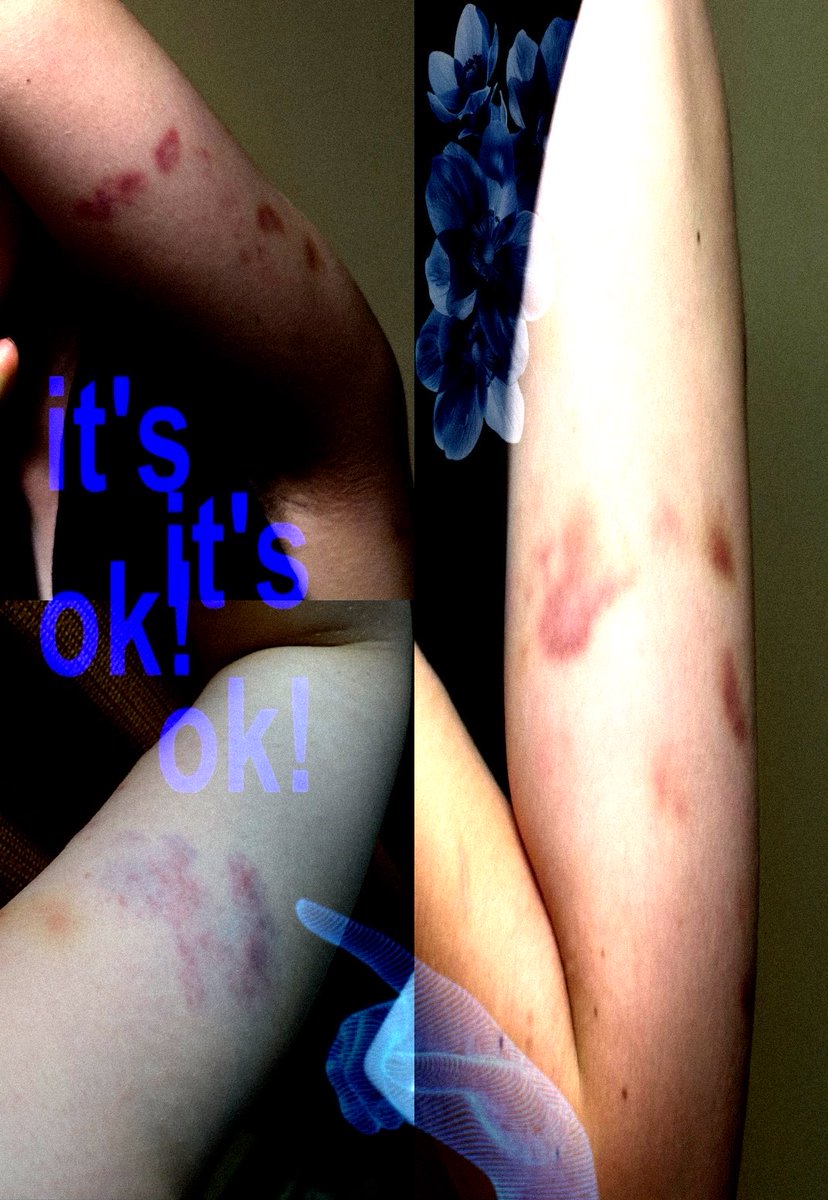 illusoryacc2's tweet photo. #bruises from da pit

                           i <3 them so bad    #shrtwt #shedrtwt https://t.co/4SwfK7Zlpa