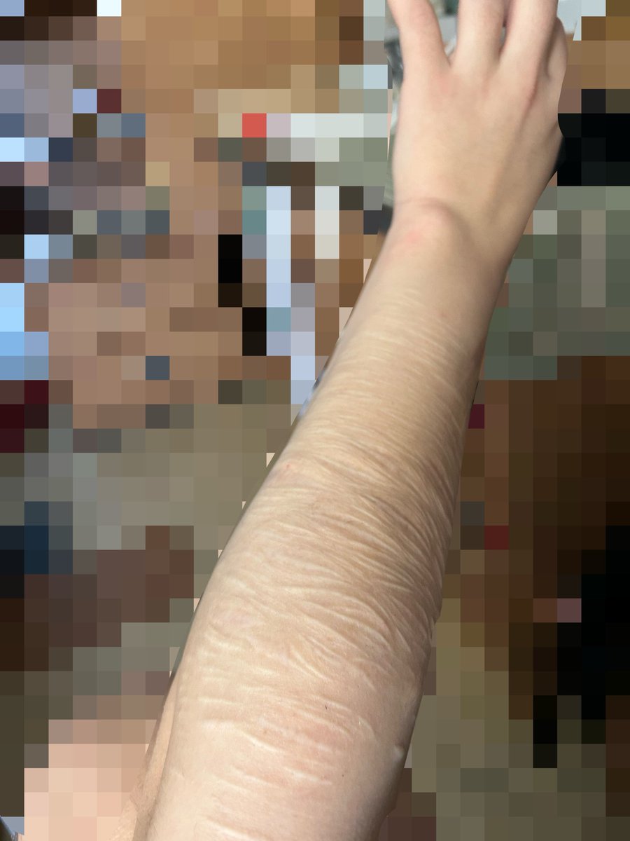 SpoonSelfharmss's tweet photo. Shaved my arm cuz why not https://t.co/KxAKPHwHvz
