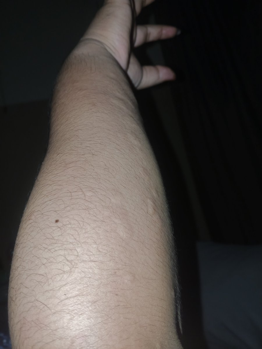 jerdiksz2's tweet photo. gate bgt anjg pdhl sepre udh ganti, mandi dah bersih tpi ttp gatel bgttt ini penyakit apasihh namanya? https://t.co/djP8yLhuhx