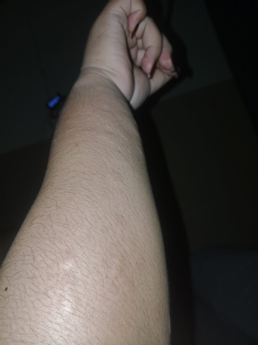 jerdiksz2's tweet photo. gate bgt anjg pdhl sepre udh ganti, mandi dah bersih tpi ttp gatel bgttt ini penyakit apasihh namanya? https://t.co/djP8yLhuhx