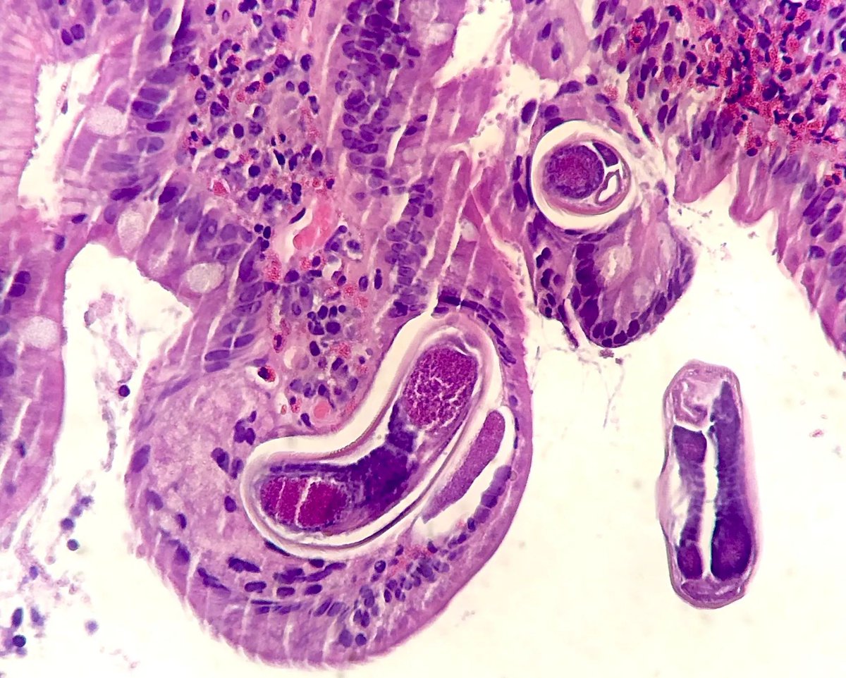 Gloria_SuraMD's tweet photo. Duodenal biopsy revealing larvae of what organism? Answer: https://t.co/WWyRo7KcbY #PathTwitter #IDTwitter #MedTwitter #PathArt https://t.co/lTcupFDU5H