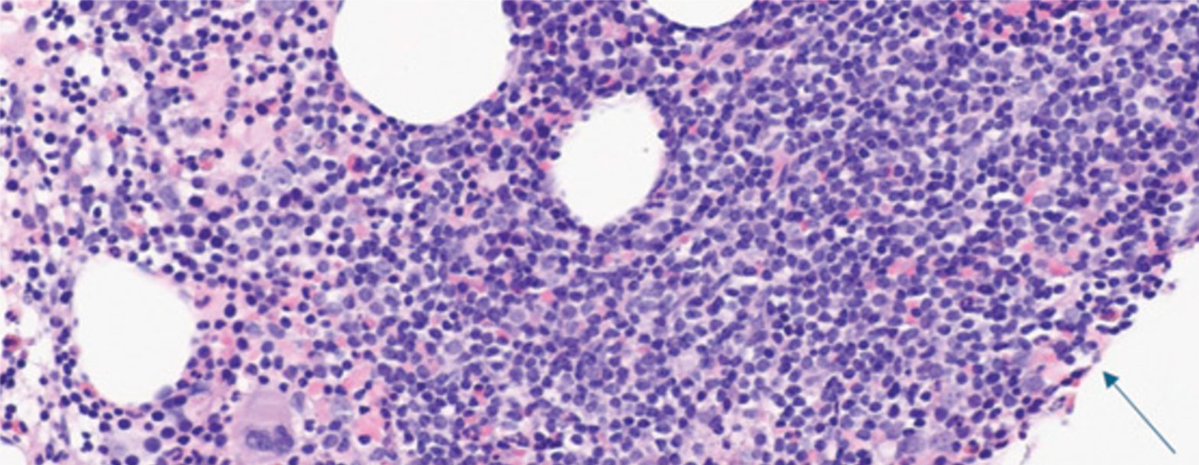 jppathpd's tweet photo. Dx? bone marrow IHC:CD138 MYD88 L265P detected
#Pathkeys https://t.co/VT9i5Sc9mY