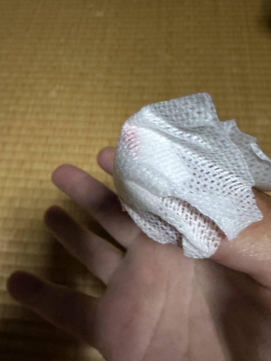 chimaru4444's tweet photo. 今日は夕方から1��間と思って､アーモンド風ピーナッツを新規開拓の池で試すと、反応良し👍
連発でこれからと言う時に、バスのもがきに私の親指にダブルフックがヒット...。
自分で抜こうとしましたが30分粘って119番で空いている病院を聞いて、1時間くらいかけて針を外して貰いました😭 https://t.co/IFWDDJvKPL