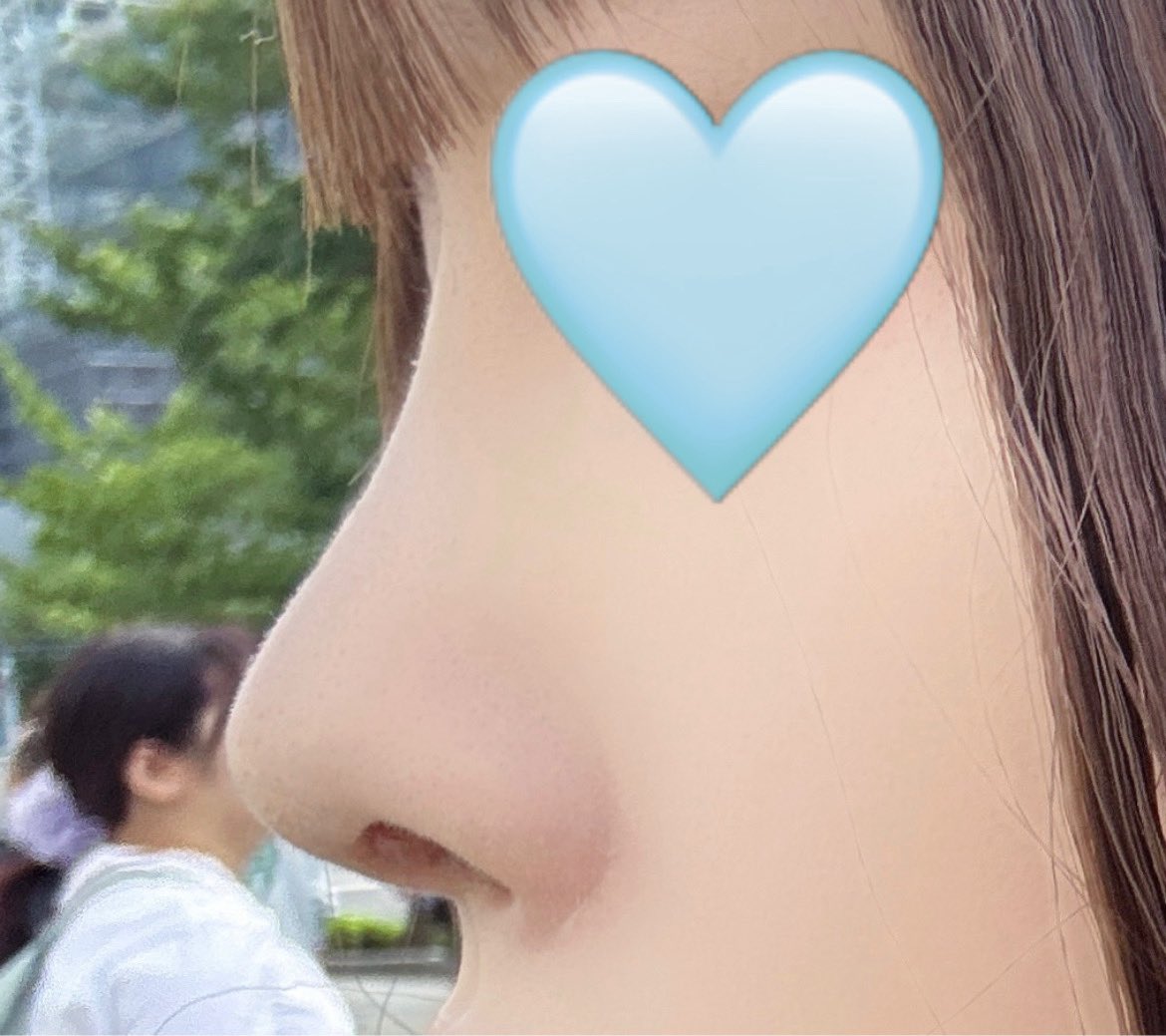 molixx25's tweet photo. fint美容外科で鼻整形をして1ヶ月が経ちました！
理想通りの鼻にしてださって大満足です！綺麗に仕上げてくださりありがとうございました🙏🏻✨ https://t.co/V4SiBFGlqg
