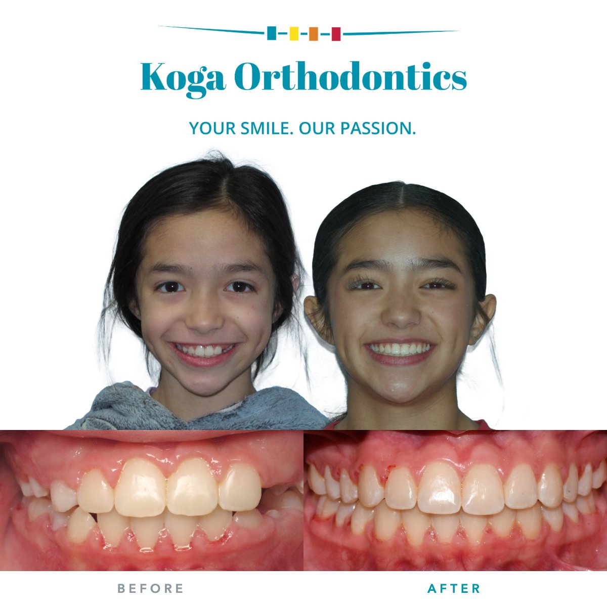 kogaortho's tweet photo. Emily came in for gaps between the teeth. The braces are off and the smile is now complete.
#KogaOrtho #beforeandafter https://t.co/0g7z2ryWIn