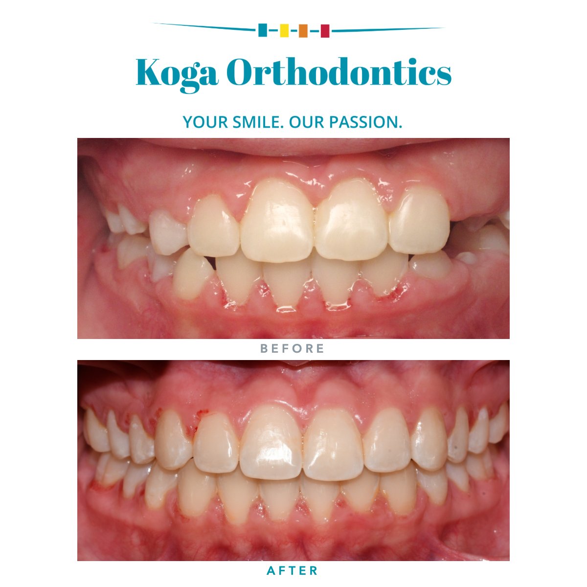 kogaortho's tweet photo. Emily came in for gaps between the teeth. The braces are off and the smile is now complete.
#KogaOrtho #beforeandafter https://t.co/0g7z2ryWIn