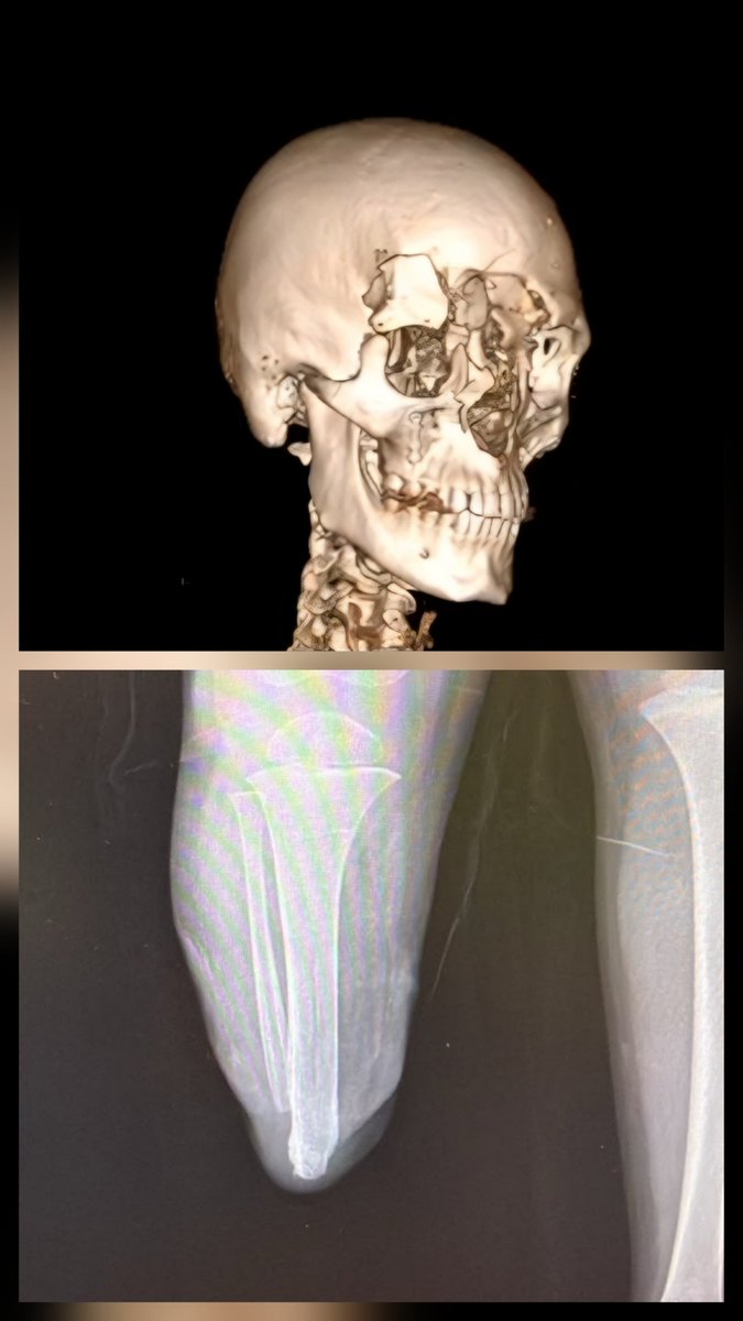 GhassanAbuSitt1's tweet photo. Rough operating  day:
  9 year old girl from Gaza. Shoulder reconstruction. Both parents killed. Cared for by uncle.
  5 year old boy from Gaza. Right lower limb amputation. For revision of stump so he can start fitting a prosthesis.
 Medical student from Lebanon, early twenties. Blast Injury to face with loss of both eyes. For reconstruction of facial bones and eyelids so he can have glass eyes fitted.

To top the day off, message from lawyers: High Court Appeal case by GMC, court date set for end of January 2027.